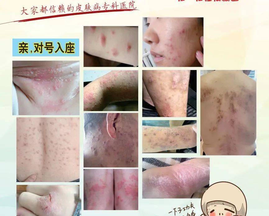 【护肤事项】哪些皮肤病有传染性?