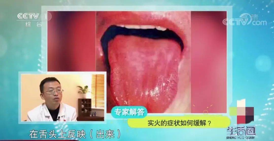 实火:舌头颜色偏深红色,甚至很多人伴有舌苔黄厚,还会出现口舌生疮