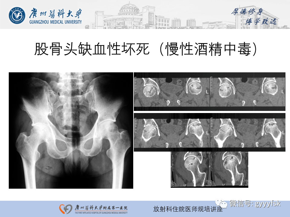 骨缺血性壞死影像學表現及診斷