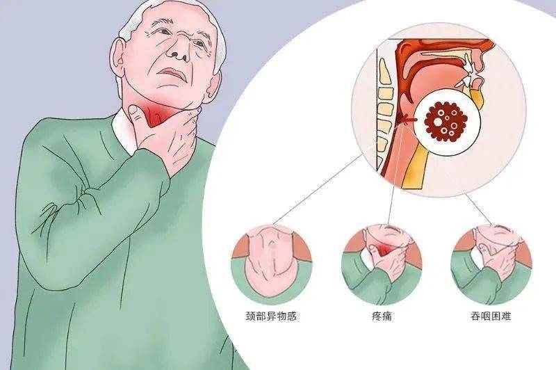 胸腔鏡腹腔鏡聯合技術解高齡老人食管癌痛苦