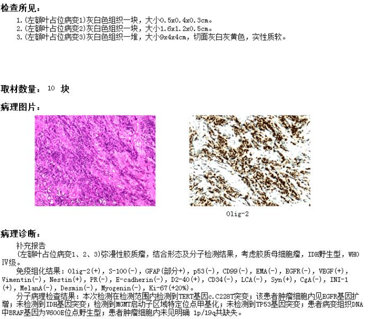 术后72小时mri术前3d slicer影像重建:绿色为肿瘤,红色为大脑前动脉