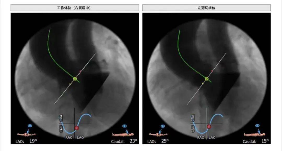 工作体位:lao:19° cau:23°;左冠切线位:lao:25° cau:15°rca:13.