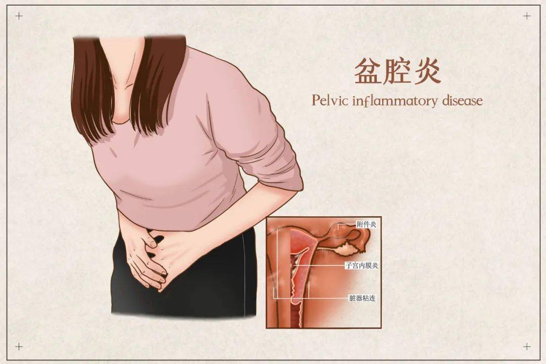 女性下腹经常隐痛坠胀要警惕盆腔炎