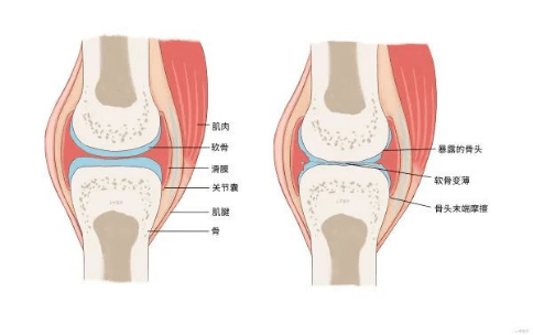 中医在身边爸妈腿疼要警惕丹东市中医院骨科专家支招巧妙应对骨关节炎