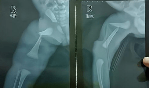 怎么看小孩有没有骨折 fbb52bdb07e74853abe2abcf654e8a7e.png