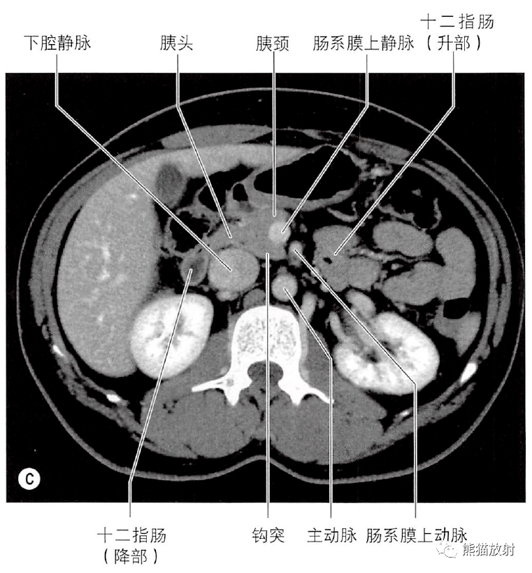 图像胰头和颈,胰尾水平横截面及对应的轴位ct胰管解剖学变异胰腺的