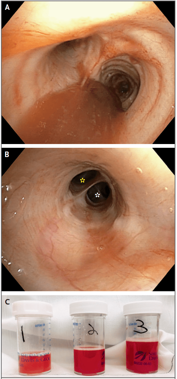 这个脂肪栓塞综合征的少见病因涨见识了
