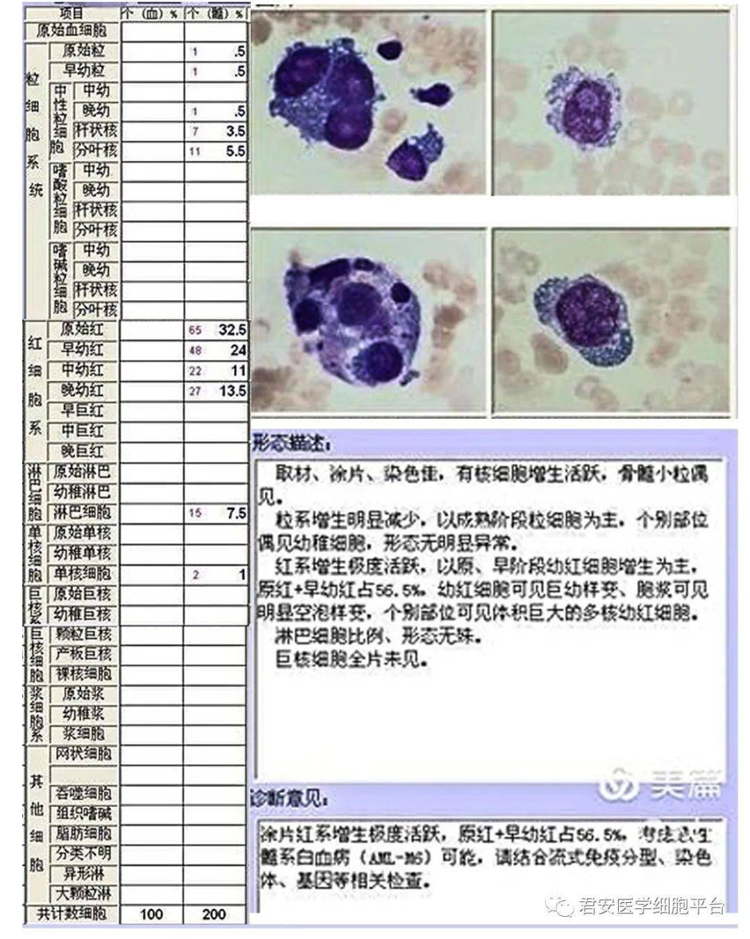 白血病骨髓报告单图片
