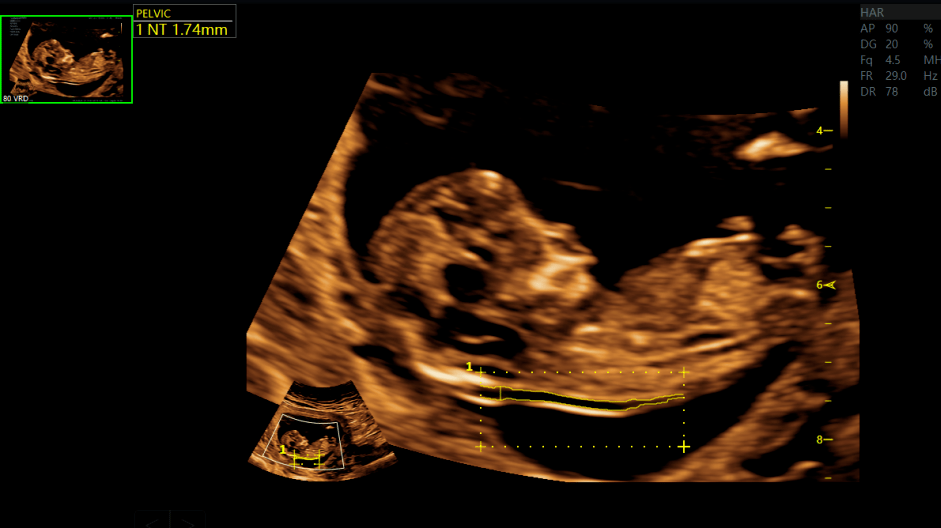 nt颈项透明层厚度自动测量为了准确测定孕期,医生还会测量胎儿的头臀