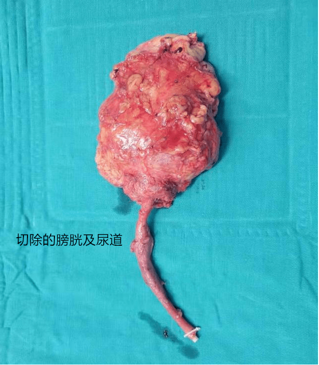 尿道癌早期症状女图片图片