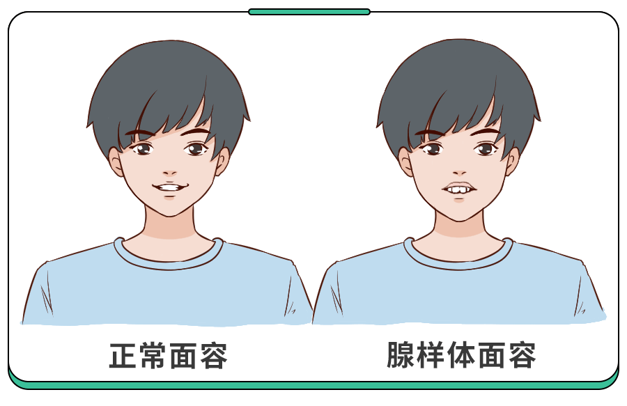 比如颌骨变长,腭骨高拱,牙列不齐,上切牙突出,唇厚,缺乏表情等情况.