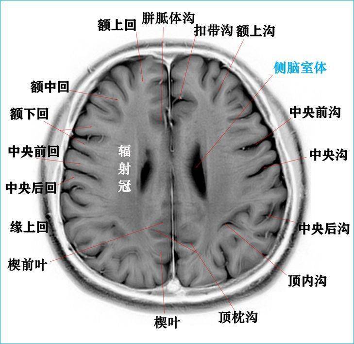 收藏高清顱腦斷層解剖圖譜