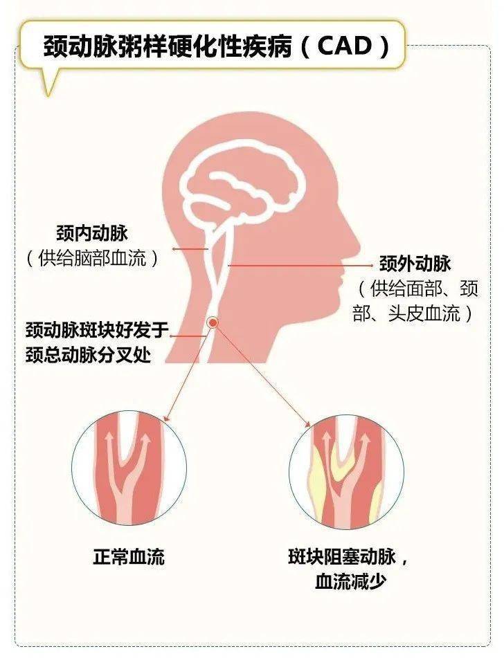 颈动脉内中膜增厚,颈动脉斑块和颈动脉狭窄或闭塞,是同一种疾病的不同