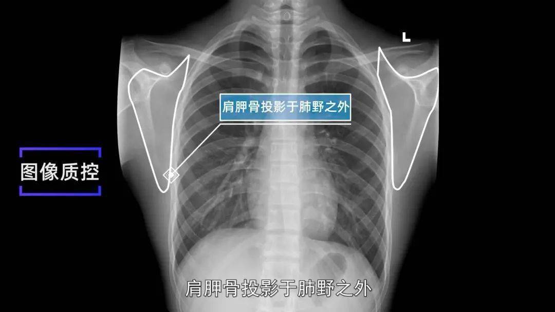 4 肩胛骨投影于肺野之外3 肺尖充分显示2