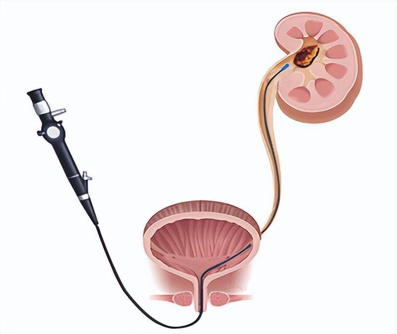 泌尿系结石手术治疗还是体外冲击波碎石医生一文讲清优缺点
