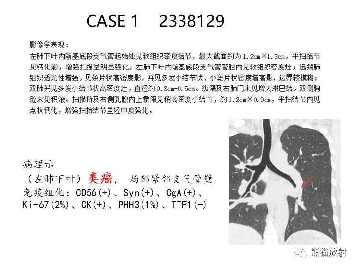 省立影像读片支气管肿瘤2203