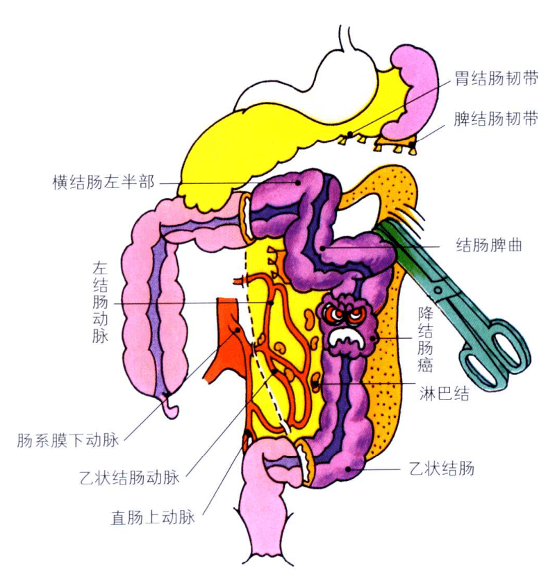 2. 右半結腸切除術適用於盲腸,升結腸及結腸肝曲部的癌腫.3.