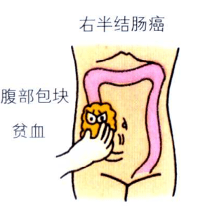 2  腹部摸到肿块 通常意味着肿瘤已发展到一定程度 1