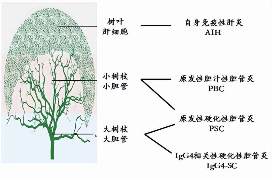 可以将肝脏想象成一棵大树,树叶比作肝细胞,小树枝比作小胆管,大树枝