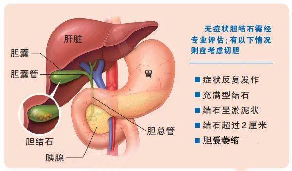 查出胆结石切不切除胆囊发现身体这四个信号要小心