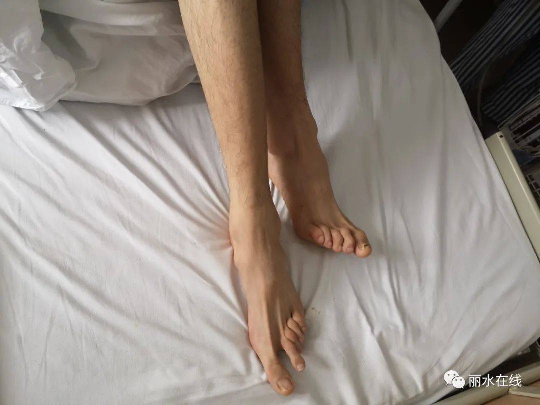丽水一男生身高1米9 ,手长脚长,没想到居然是得了"天才病"!