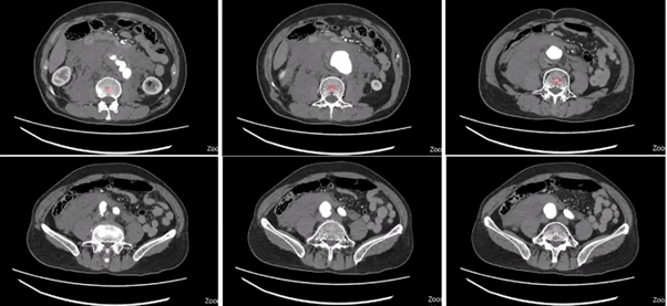 主动脉cta:腹主动脉(l2水平以下)及右侧髂总动脉瘤并附壁血栓,溃疡斑