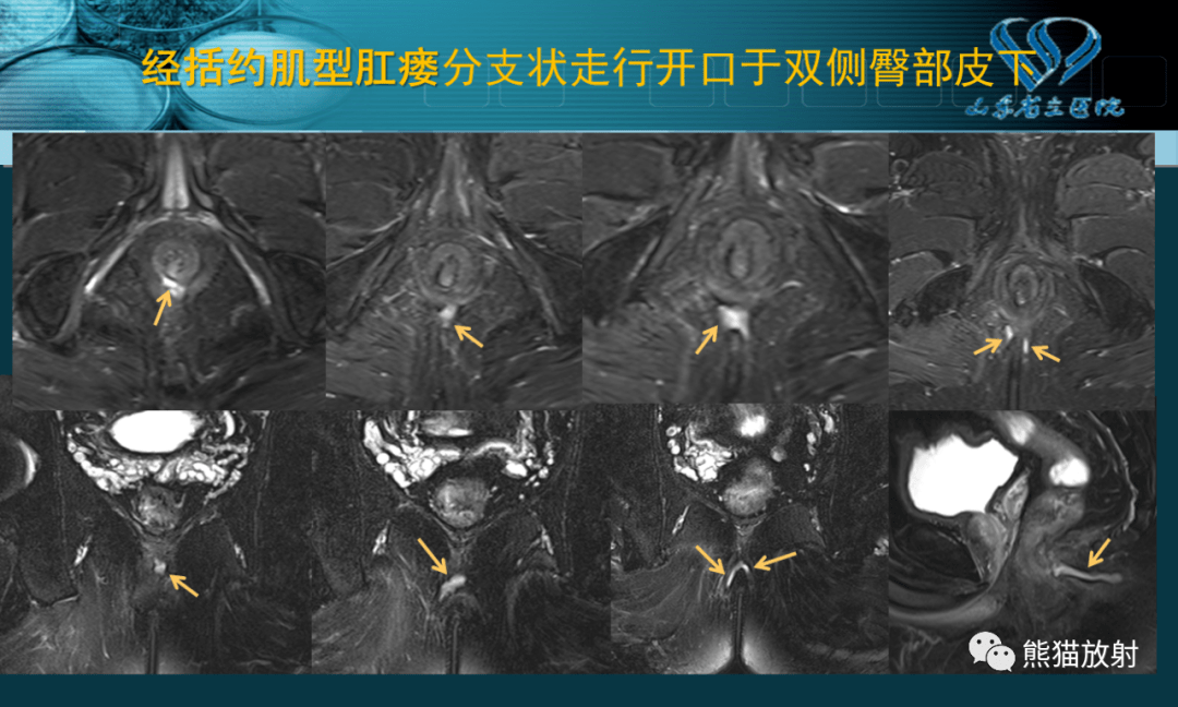 肛提肌mri图片