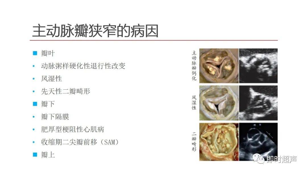 病例:男78岁,高血压病,主动脉瓣钙化主动脉瓣狭窄病例:女50 胸闷气短