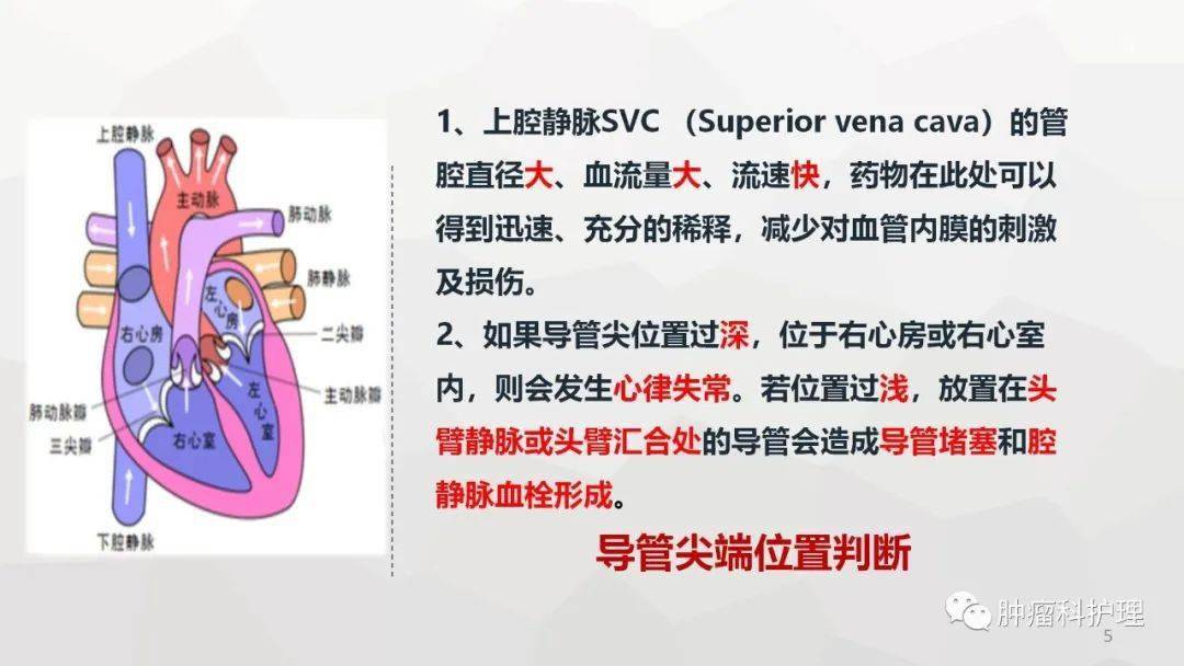 ppt腔内心电定位技术在picc置管术中的应用