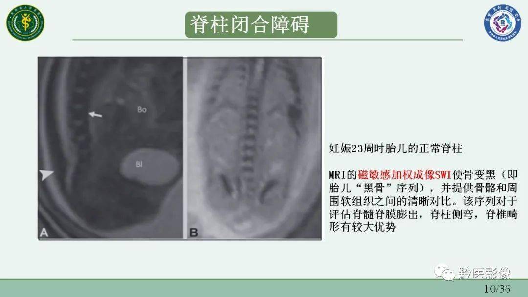 胎兒脊柱異常的多模態成像評估