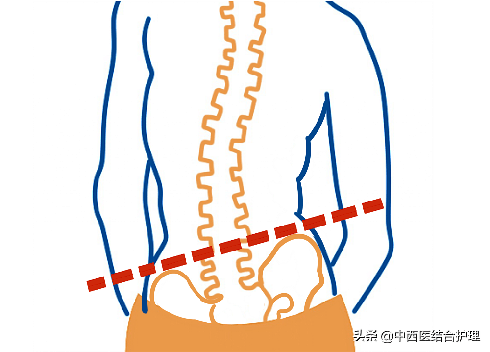 8跛行由于疼痛出现跛行步态,以及出现行走后疼痛加重,需要休息或蹲下