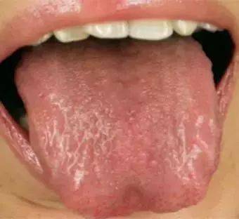 所以由于阴虚不能制火,会出现五心烦热或午后潮热,盗汗,颧红,消瘦