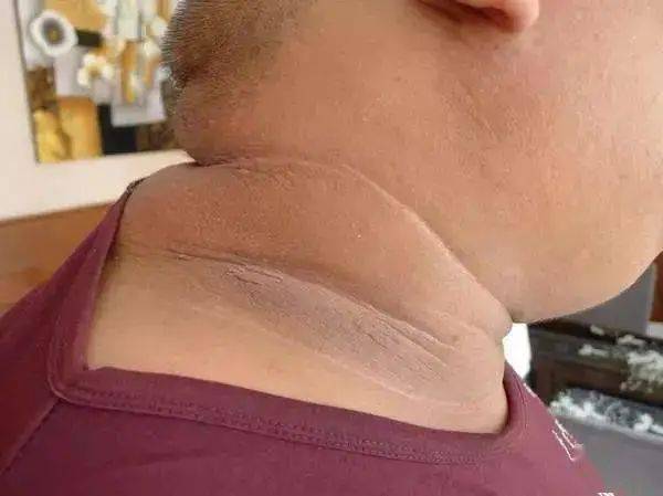 因为脖子上的黑泥,我变得不愿意出门_胰岛素_棘皮_抵抗