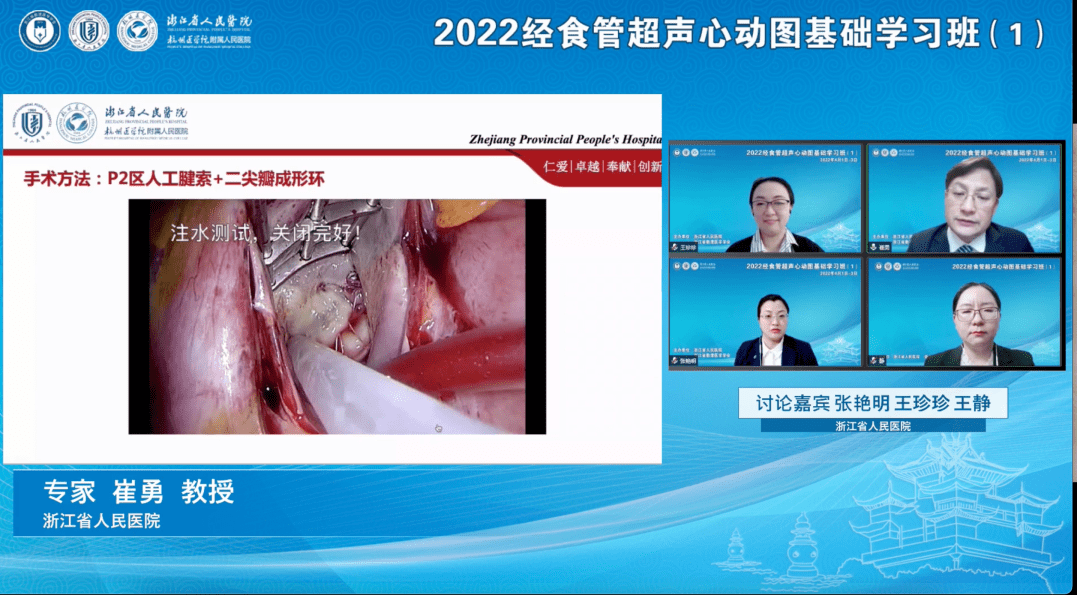 超声科王珍珍,王静,张艳明教授就肥厚型梗阻性心肌病,二尖瓣成形,主