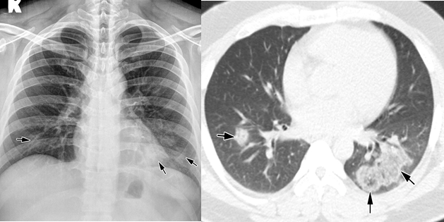 肺炎胸片图片图片