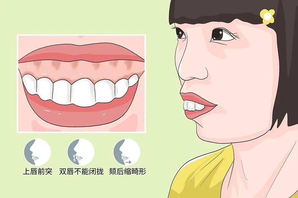 当小孩因为慢性鼻炎,鼻窦炎,鼻甲肥大,腭扁桃体或咽扁桃体肥大等鼻咽