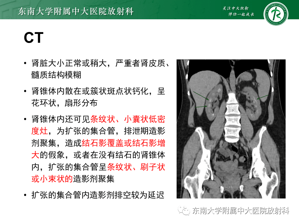 髓质海绵肾影像诊断