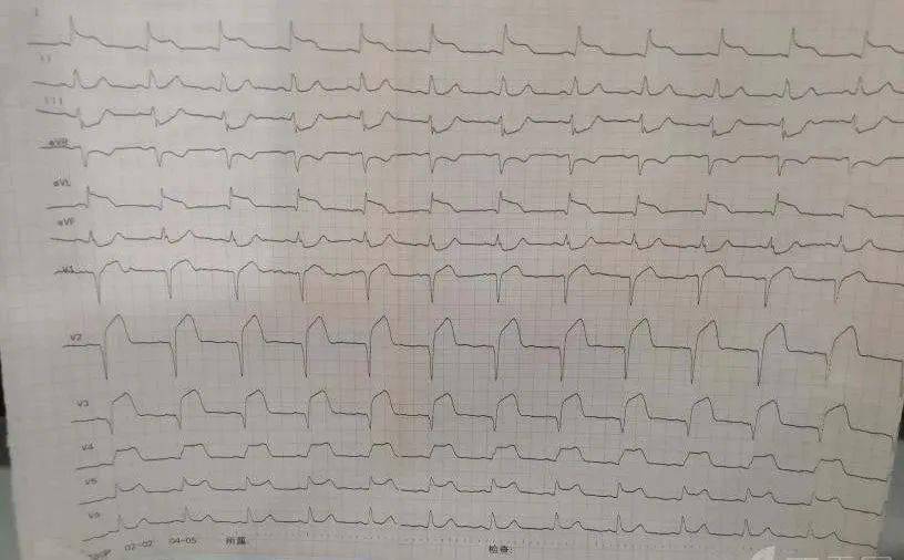 除了62这8种心电图也提示心梗危重