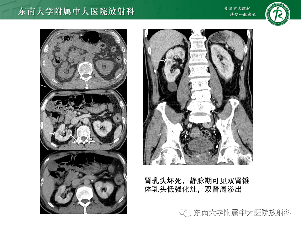 髓質海綿腎影像診斷