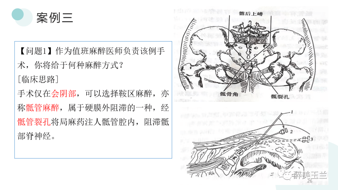 椎管内麻醉解剖图片