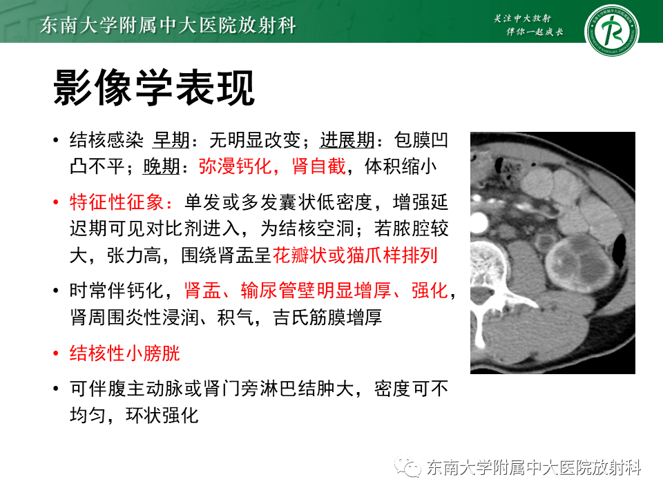 髓质海绵肾影像诊断