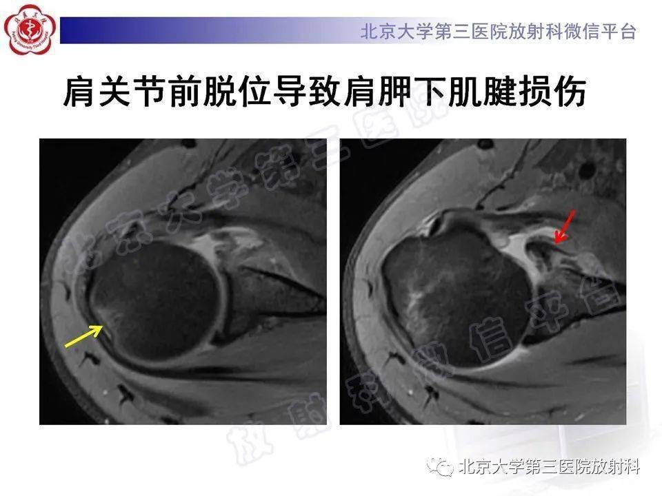 肩胛下肌腱撕裂67影像诊断