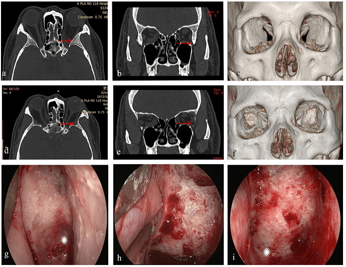 内镜下经结膜径路经眶眶外侧壁深部减压术_手术_临床_切口