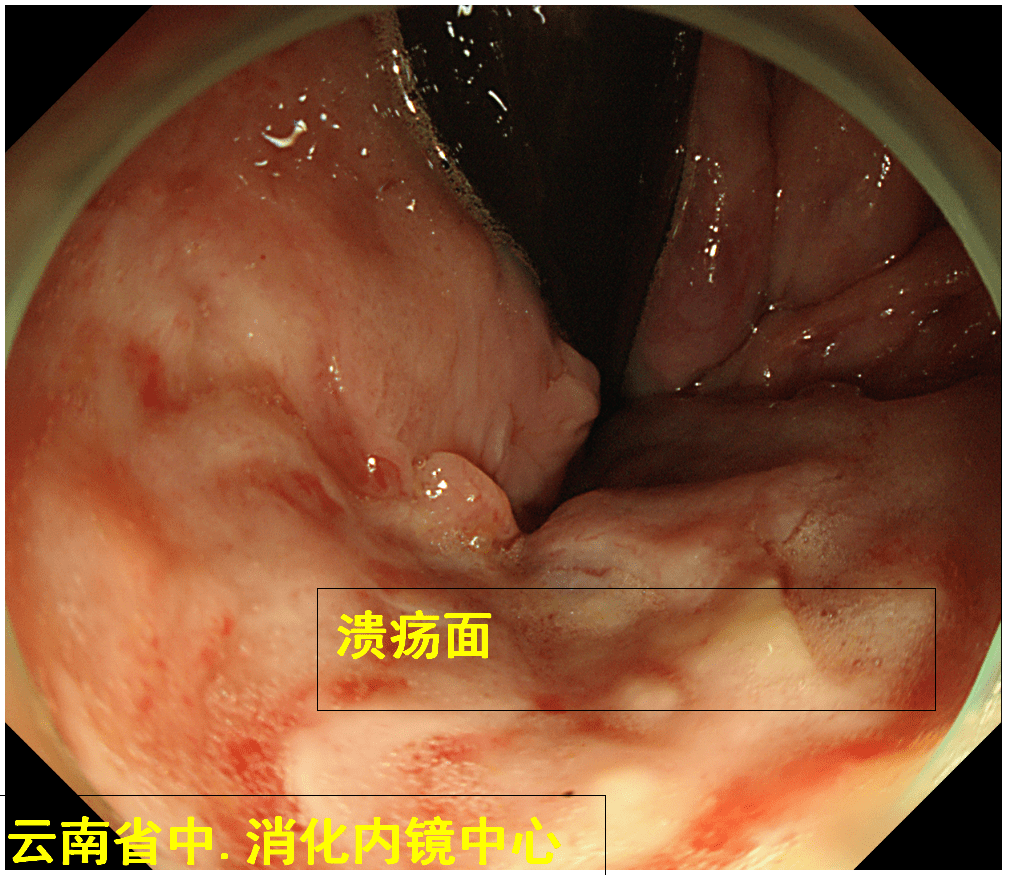 强专科我院脾胃病科消化内镜中心联合肛肠科成功抢救内痔出血的患者