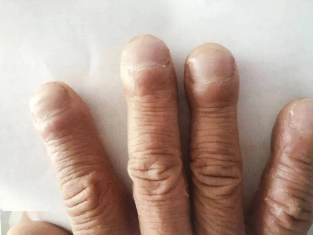 杵状指头是什么病图片