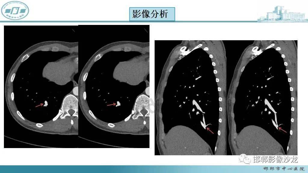 肺动静脉瘘与先天性心脏发育异常