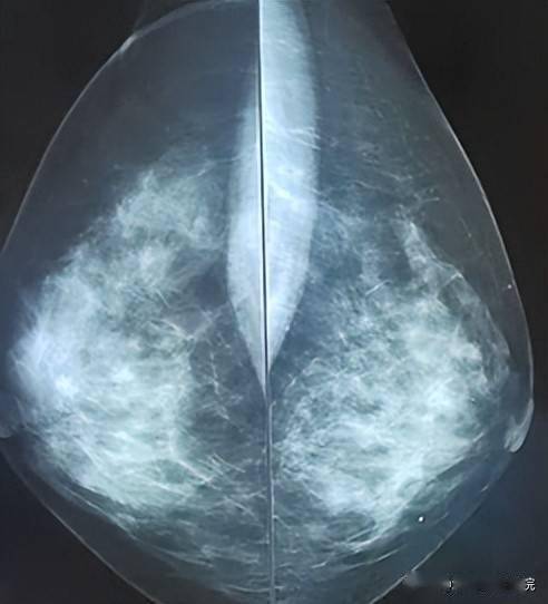 协和牵头制定中国指南发表b超是最适合国人的乳腺癌筛查手段