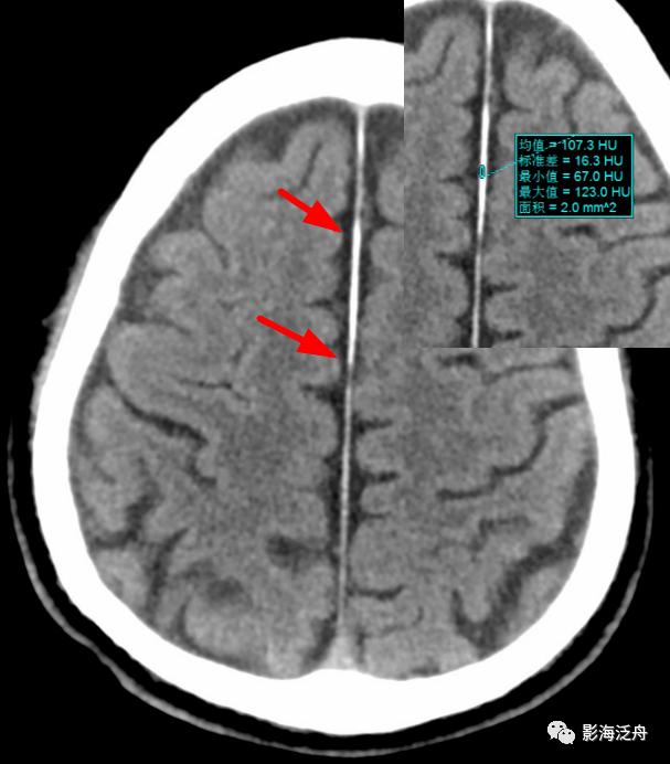 大脑镰钙化图片