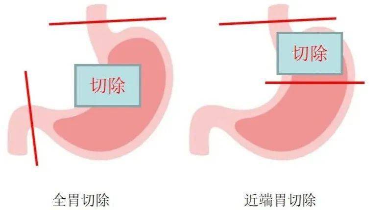 姚大爷属于胃近端的病灶,此前也可通过近端胃切除术保留部分胃,但是
