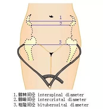 髂嵴中点位置图图片